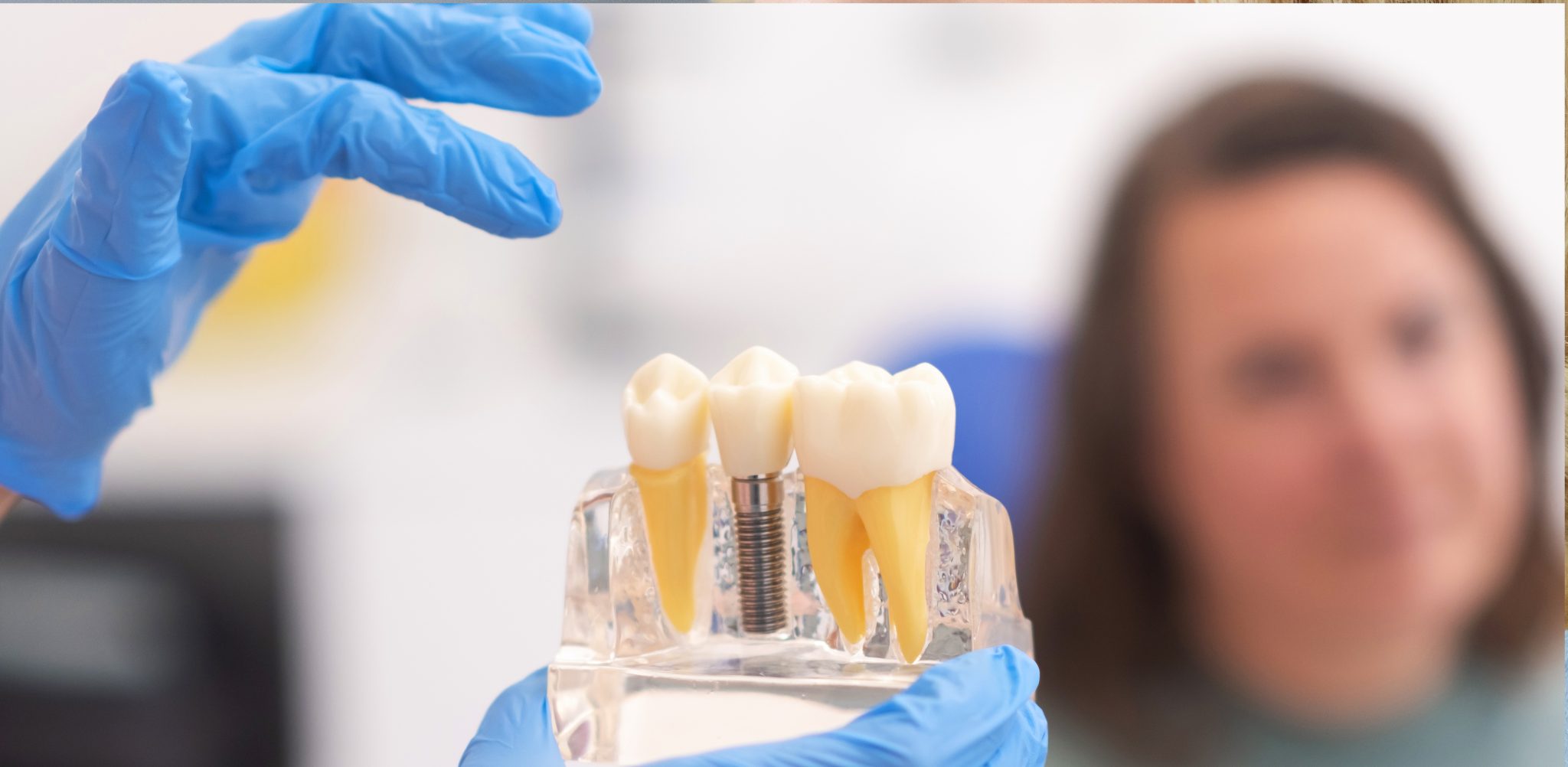 Home 5 Dental Implants 2048x1002 1